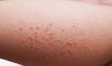 Äußere Manifestationen des Vorhandenseins von Parasiten im Körper.